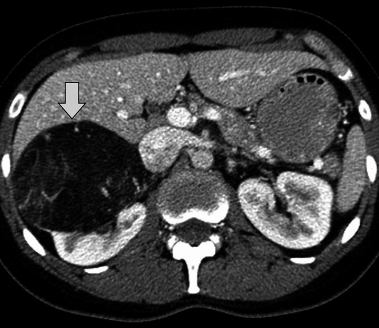 Angiomiolipoma renal