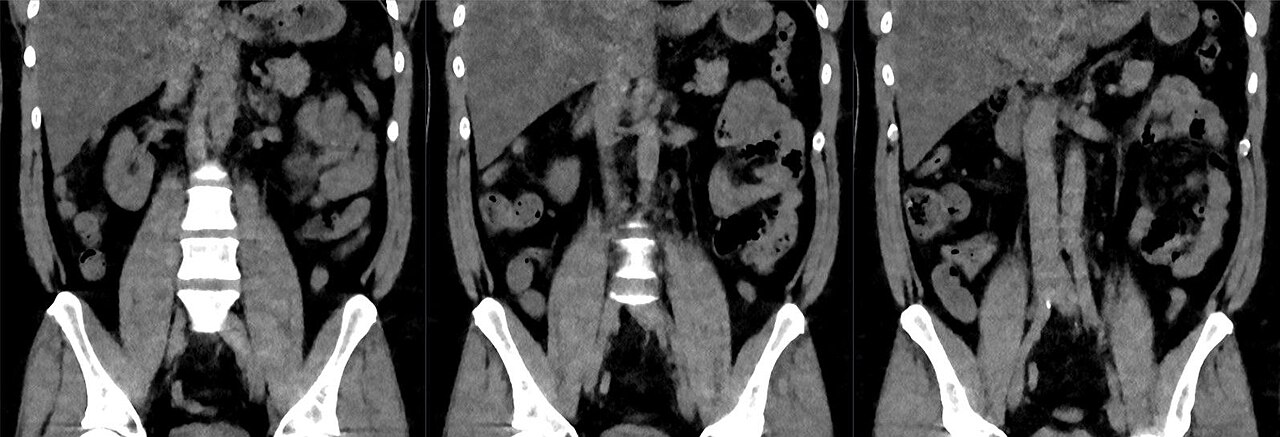 Apendicitis aguda (tomografía)