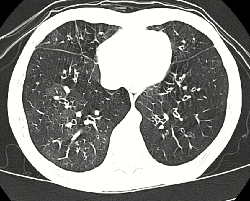 Bronquiolitis obliterante y patrón en mosaico