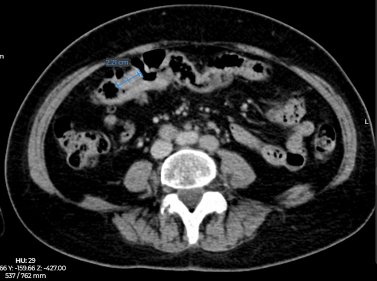 Cáncer colorrectal