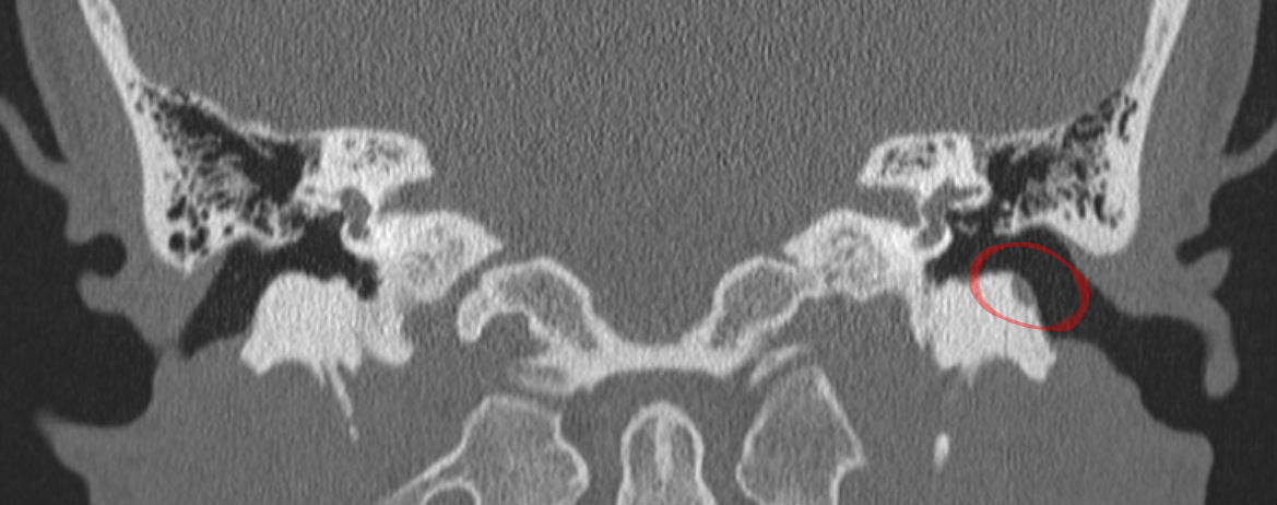 Colesteatoma adquirido