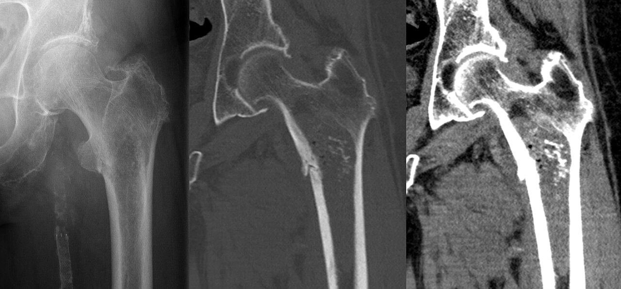 Condrosarcoma