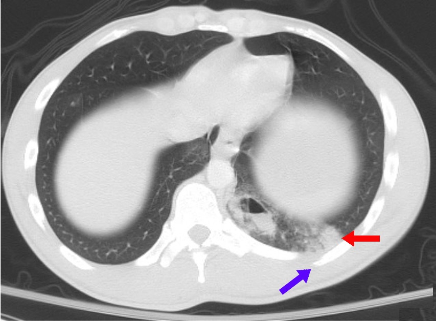 Contusión pulmonar y trauma torácico