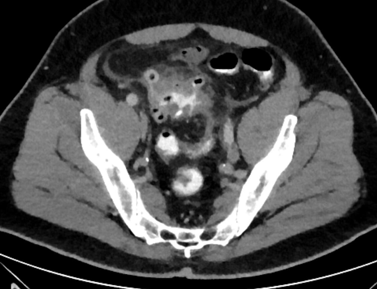 Diverticulitis aguda