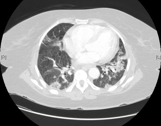 Fibrosis pulmonar y patrón de neumonía intersticial usual