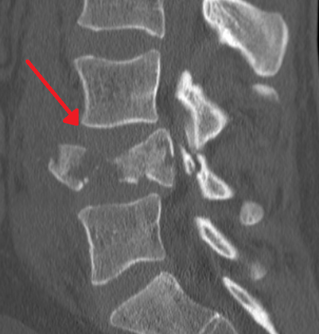 Fractura vertebral por estallido