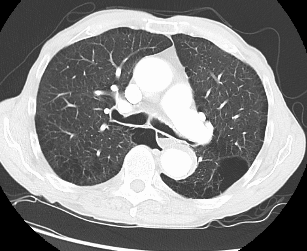 Hipertensión pulmonar