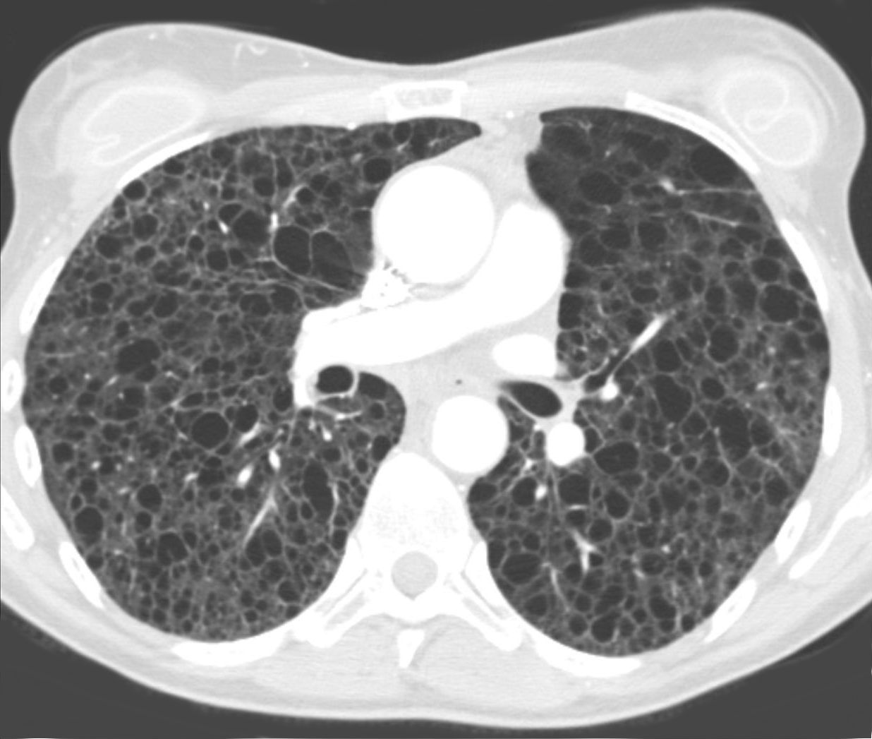 Linfangioleiomiomatosis