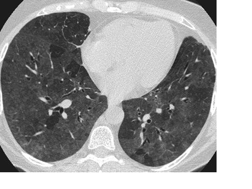 Neumonitis por hipersensibilidad