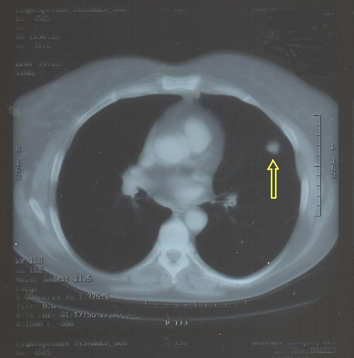 Nódulo pulmonar solitario: Caracterización y seguimiento