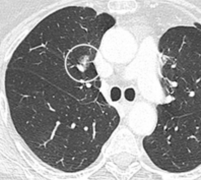 Nódulo pulmonar subsólido
