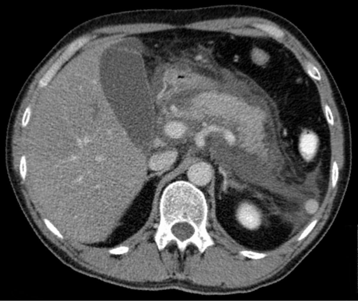 Pancreatitis aguda
