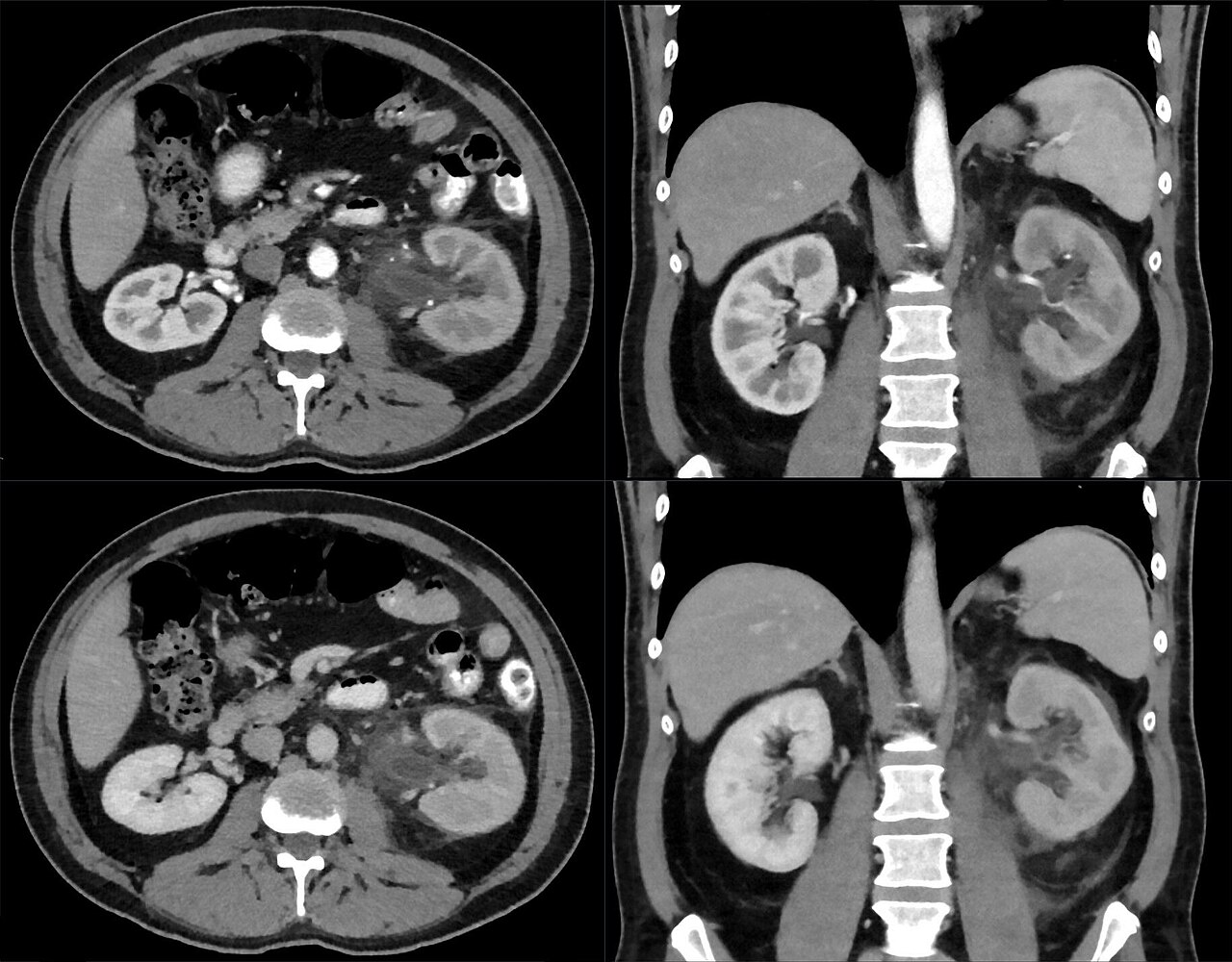 Pielonefritis aguda