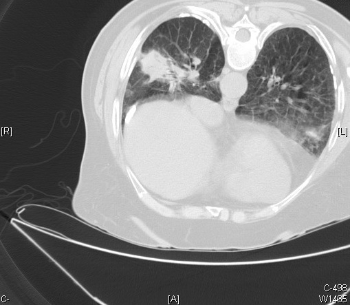Patología pleural por asbesto y mesotelioma