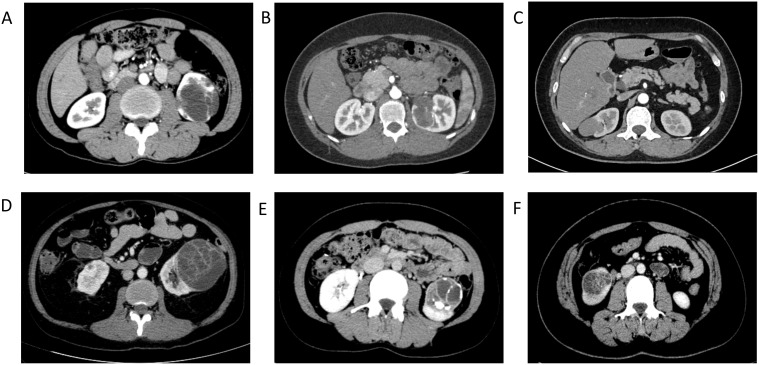 Quiste renal complejo