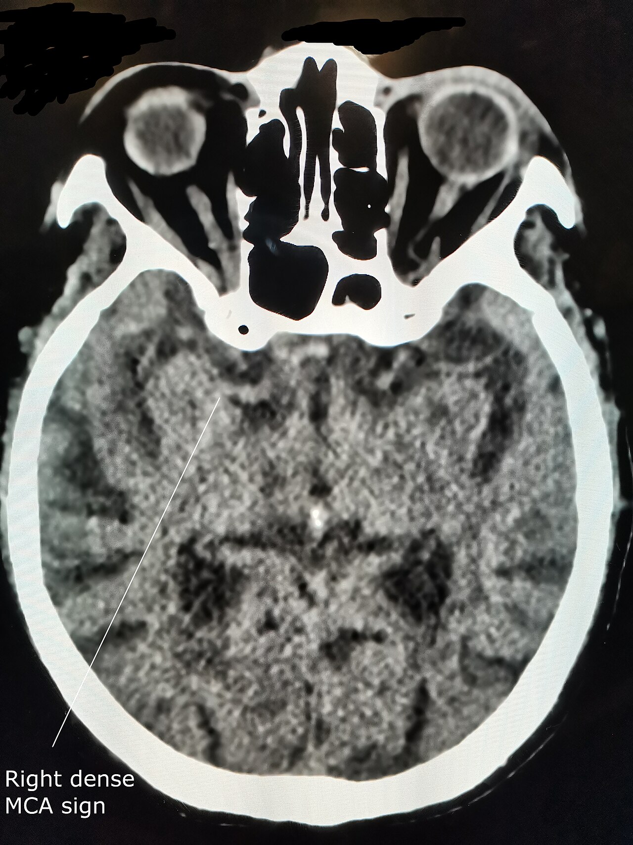 Signos precoces de infarto en tomografía simple