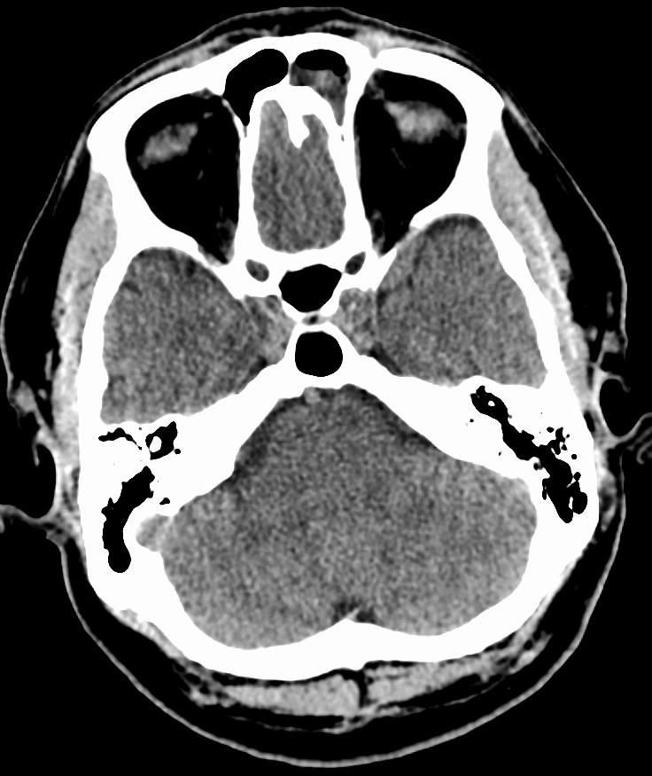 Sinusitis aguda