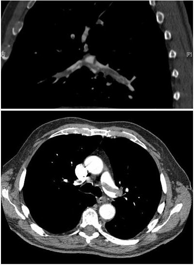 Tromboembolia pulmonar (angio-TC)