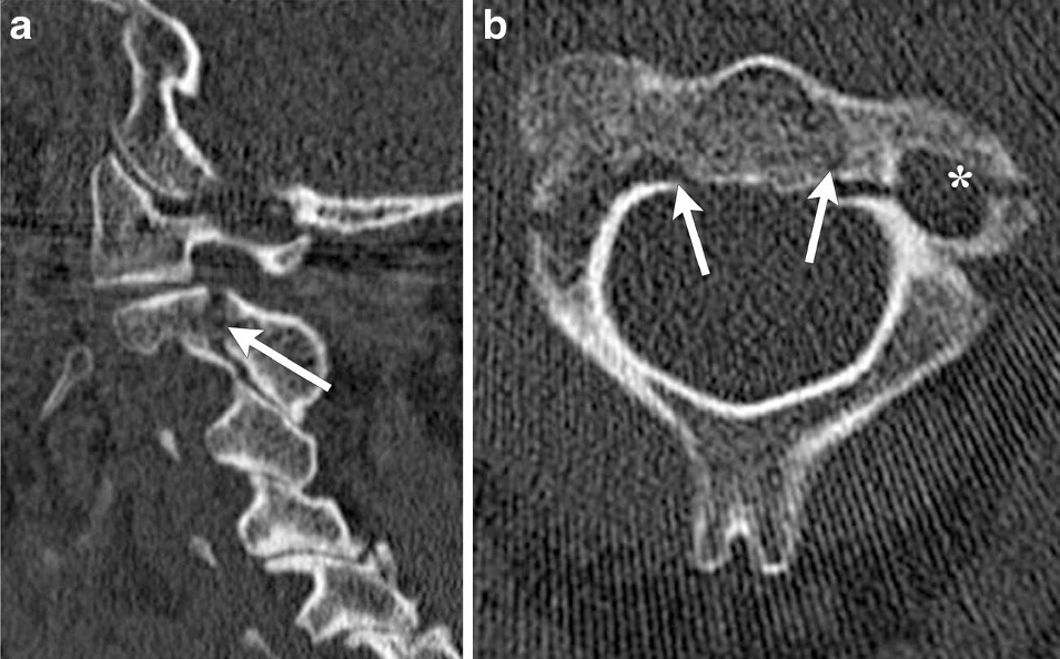 Traumatismo de columna cervical