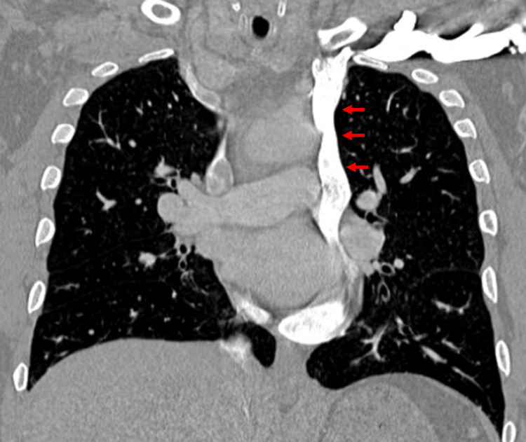 Persistencia de la vena cava superior izquierda