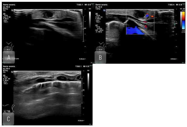 Mastitis y absceso mamario