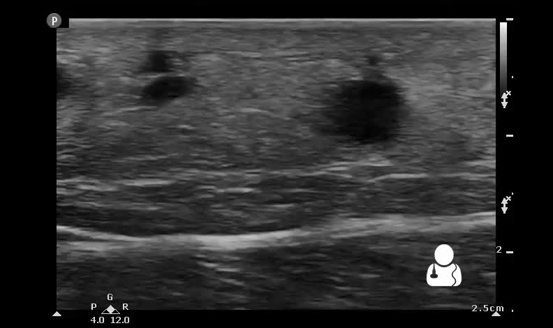 Absceso de partes blandas y celulitis