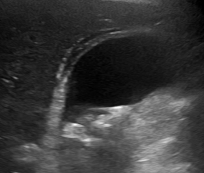 Colecistitis aguda