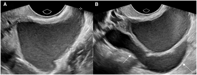 Endometrioma ovárico