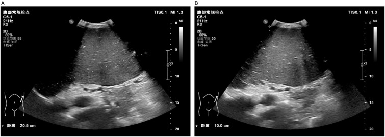 Esplenomegalia