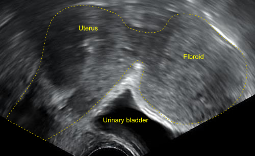 Mioma uterino