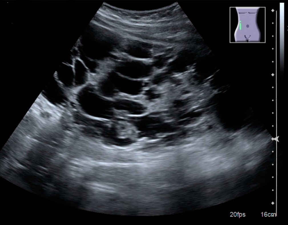 Poliquistosis renal autosómica dominante