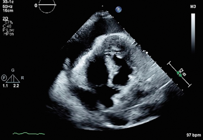 Taponamiento cardiaco
