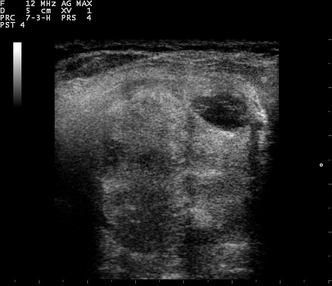 Ultrasonido de tiroides